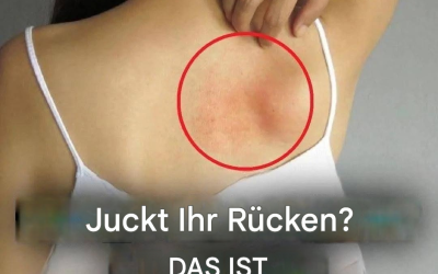 Juckreiz am ganzen Körper: Ursachen und natürliche Behandlungsmethoden (1/4)