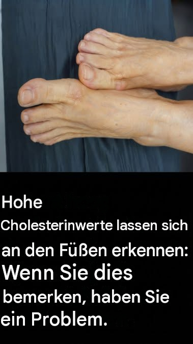 Hoher Cholesterinspiegel: Anzeichen an Ihren Beinen