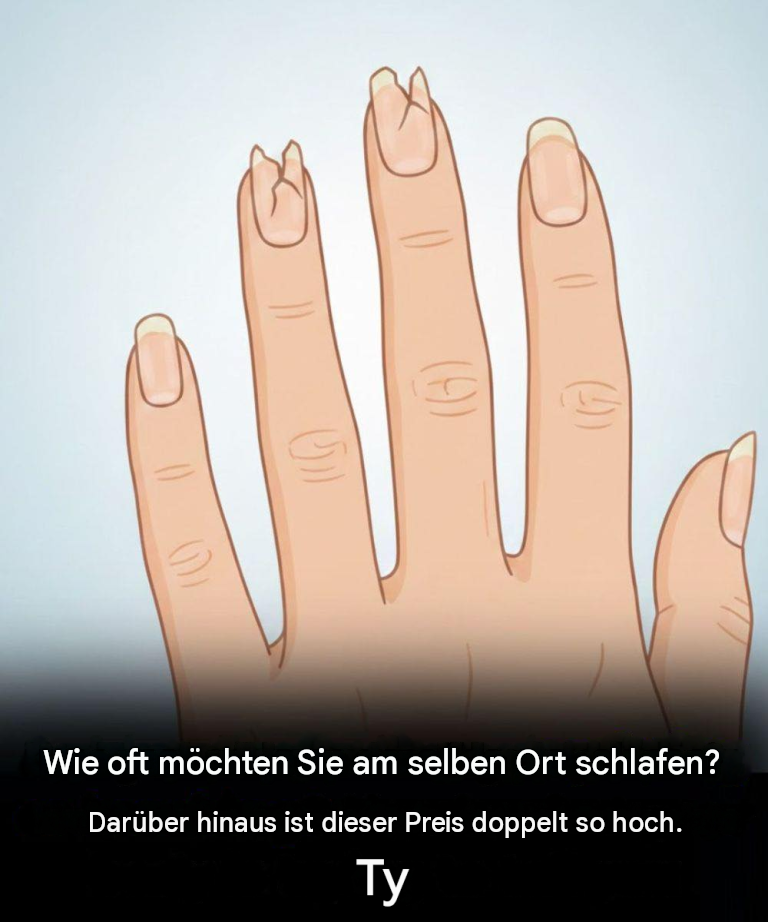 Wenn Ihre Nägel so aussehen, ist es Zeit für eine Untersuchung.