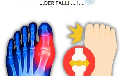 „Mein großer Zeh brannte wie Feuer… bis ich diese 5 Getränke entdeckte, die auf natürliche Weise Harnsäure abbauen!“