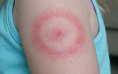 Meine Tochter ist mit einem seltsamen roten Ring am Arm aufgewacht. Er juckt nicht, scheint aber größer zu werden. Ich bin total beunruhigt; sollte ich sofort mit ihr zum Arzt gehen? Ganzer Artikel 👇 💬