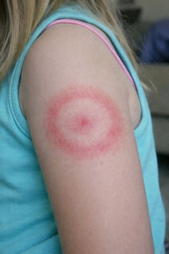 Meine Tochter ist mit einem seltsamen roten Ring am Arm aufgewacht. Er juckt nicht, scheint aber größer zu werden. Ich bin total beunruhigt; sollte ich sofort mit ihr zum Arzt gehen? Ganzer Artikel 👇 💬