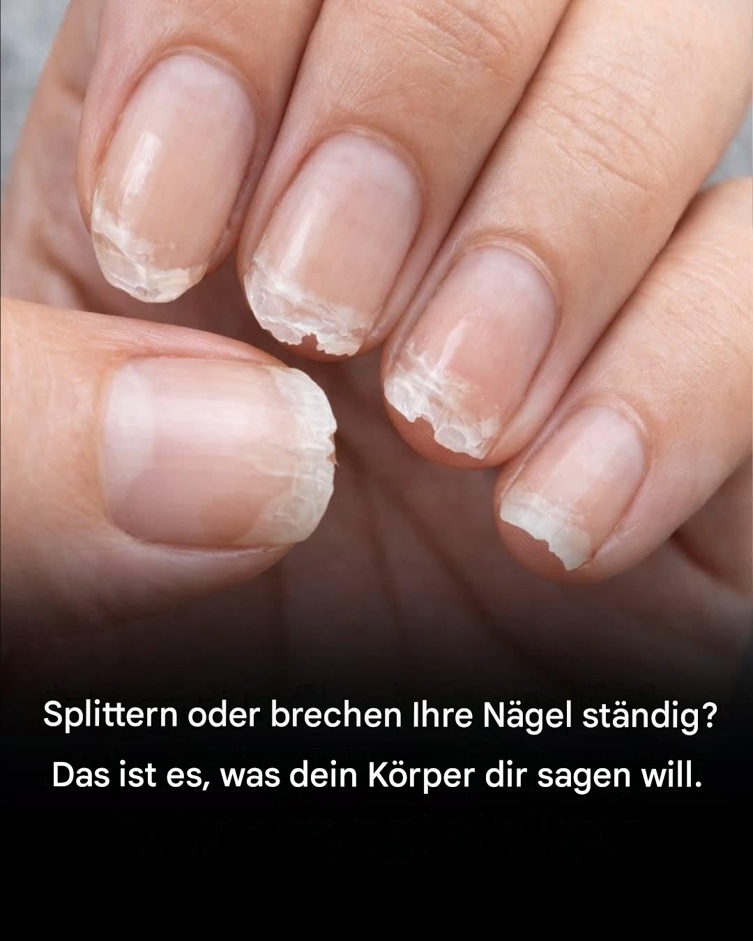 Schwache oder brüchige Nägel: Was Ihr Körper Ihnen damit sagen will