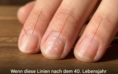 Warum bilden sich mit zunehmendem Alter dünne, vertikale Linien auf den Nägeln?