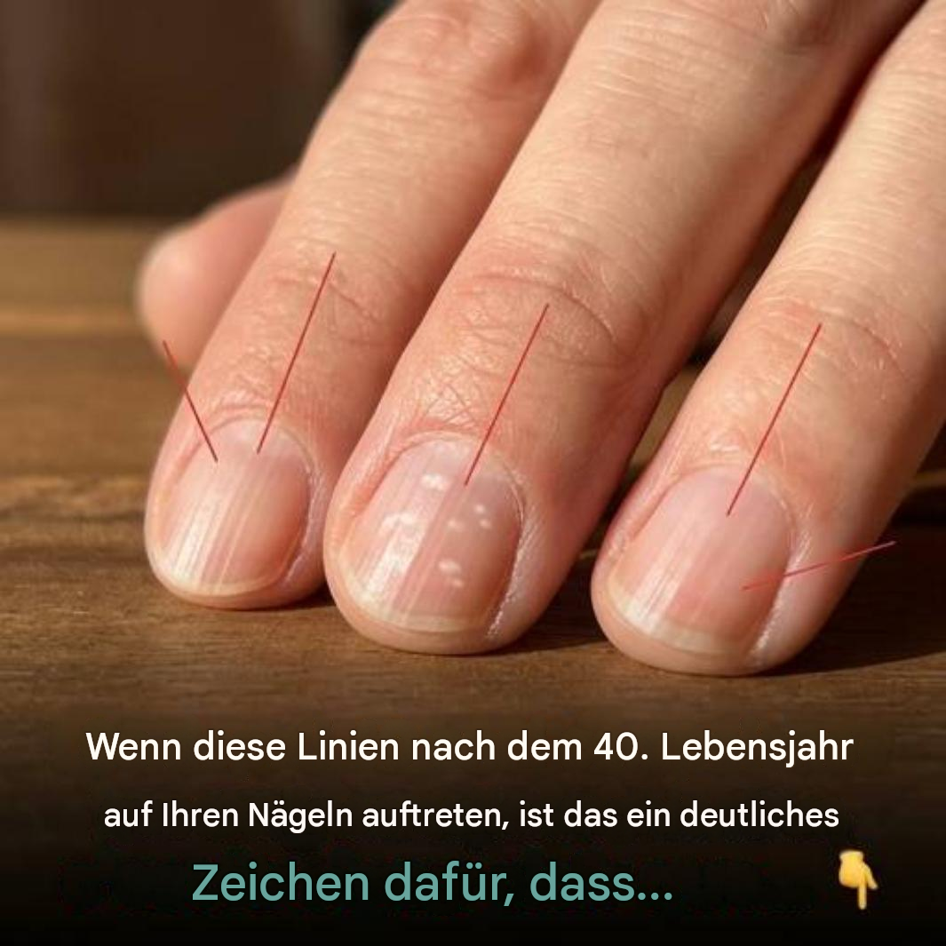 Warum bilden sich mit zunehmendem Alter dünne, vertikale Linien auf den Nägeln?