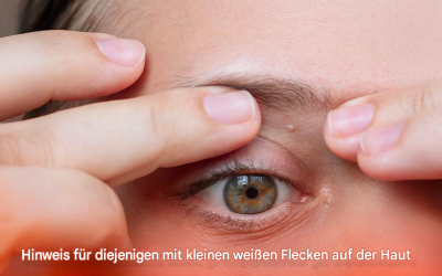 Warnung für alle, bei denen kleine weiße Flecken am ganzen Körper auftreten: Ein Arzt erklärt, wie man sie loswird.