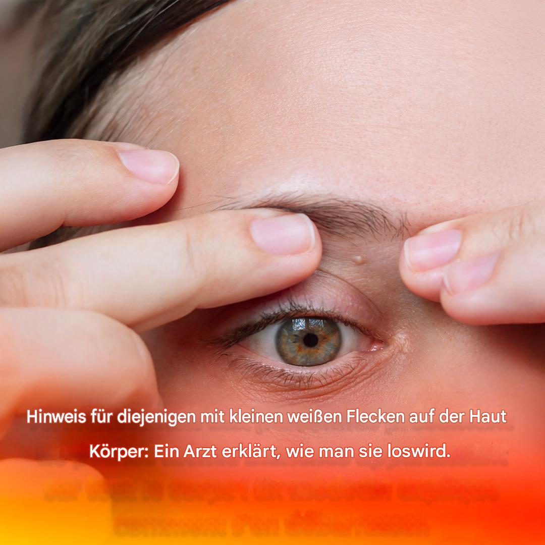 Warnung für alle, bei denen kleine weiße Flecken am ganzen Körper auftreten: Ein Arzt erklärt, wie man sie loswird.