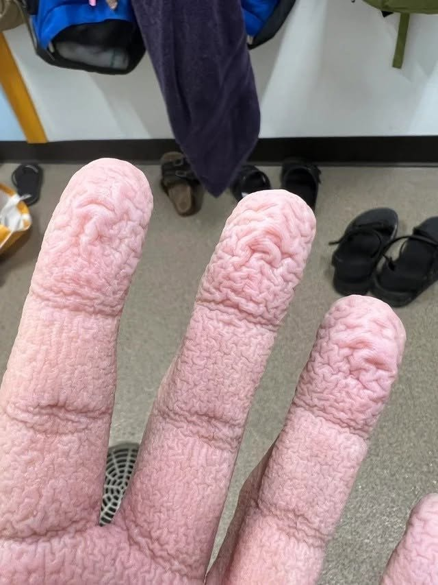 Runzelige Finger nach dem Wasserkontakt: Was Ihre Haut Ihnen möglicherweise sagen will