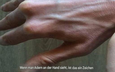 Sichtbare Venen: Häufige Ursachen, Gesundheitsrisiken und wann man sich Sorgen machen sollte.