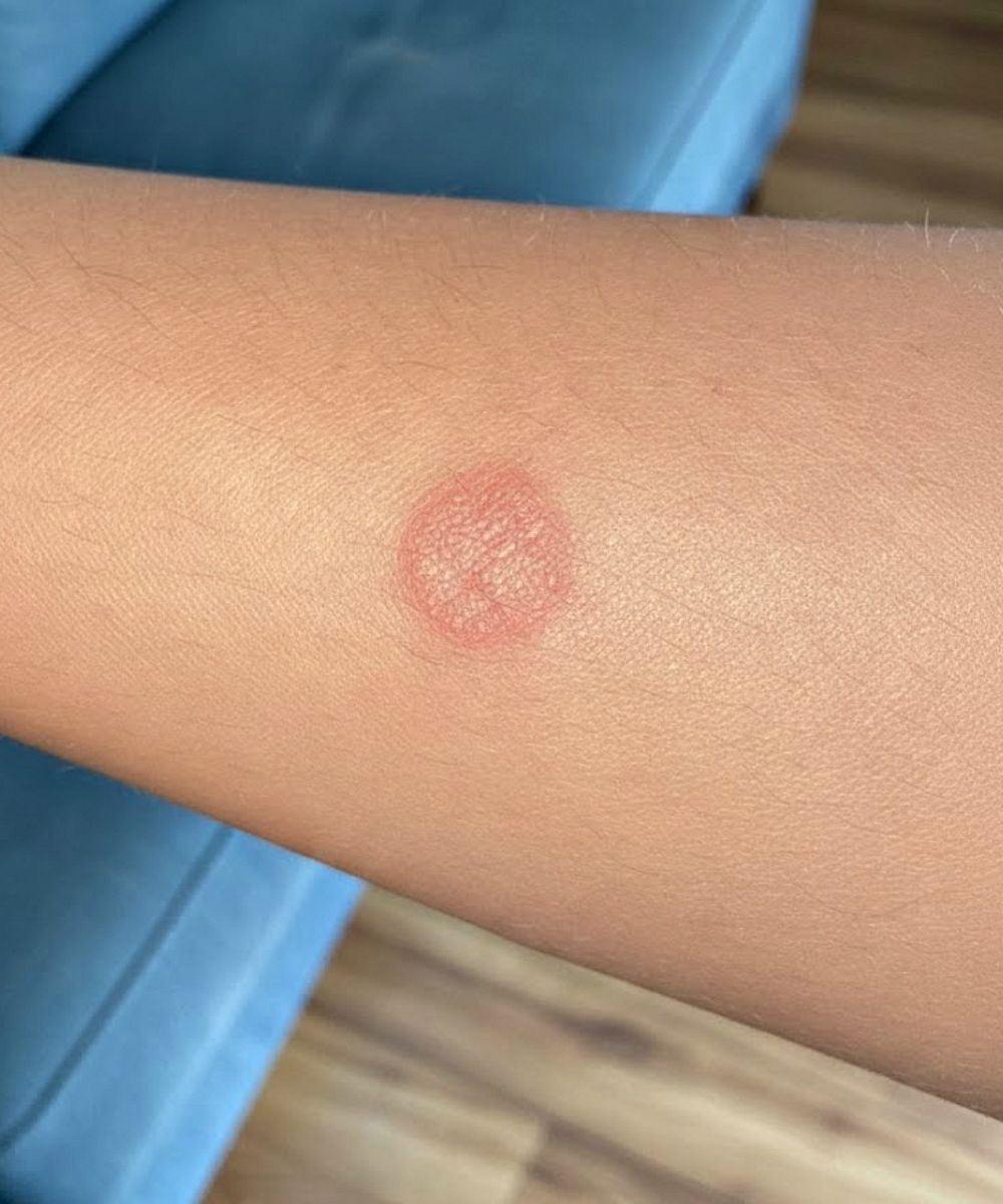 Dies sind die Anzeichen dafür, dass es sich um Cr… handelt.