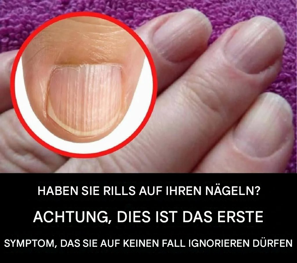 Hier erfahren Sie, warum Sie vertikale Streifen oder Linien auf Ihren Nägeln haben.