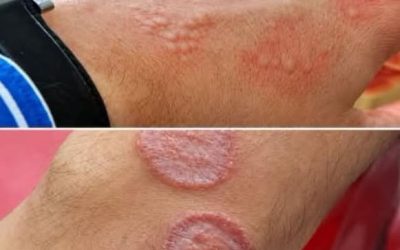 Gürtelrose: Die Krankheit, die nach Stressphasen auftreten kann, und wie man ihre Symptome erkennt