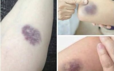 Bekommen Sie blaue Flecken, ohne sich selbst geschlagen zu haben? Diese Anzeichen können darauf hindeuten, dass in Ihrem Körper etwas vor sich geht.