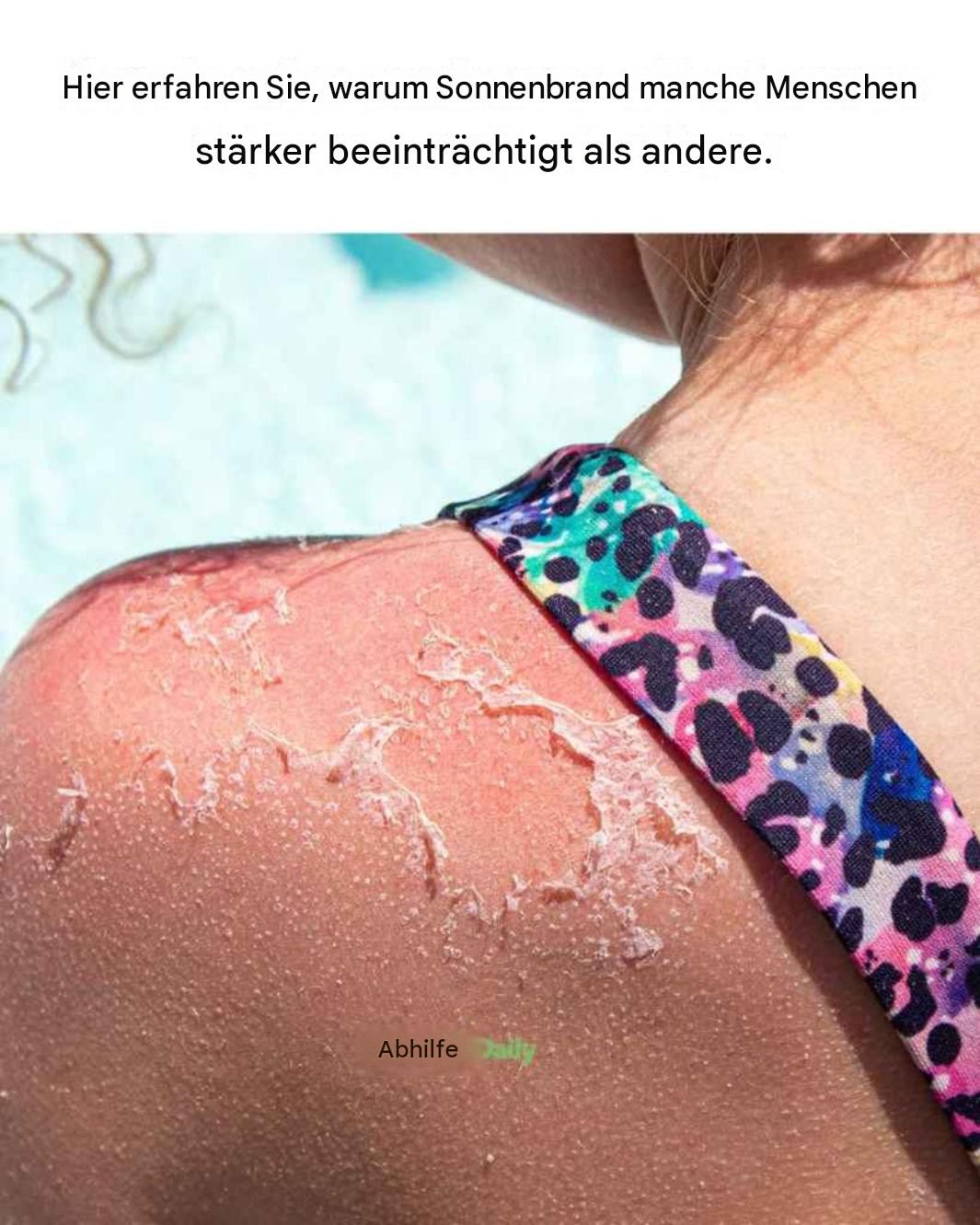 Warum manche Menschen leicht einen Sonnenbrand bekommen