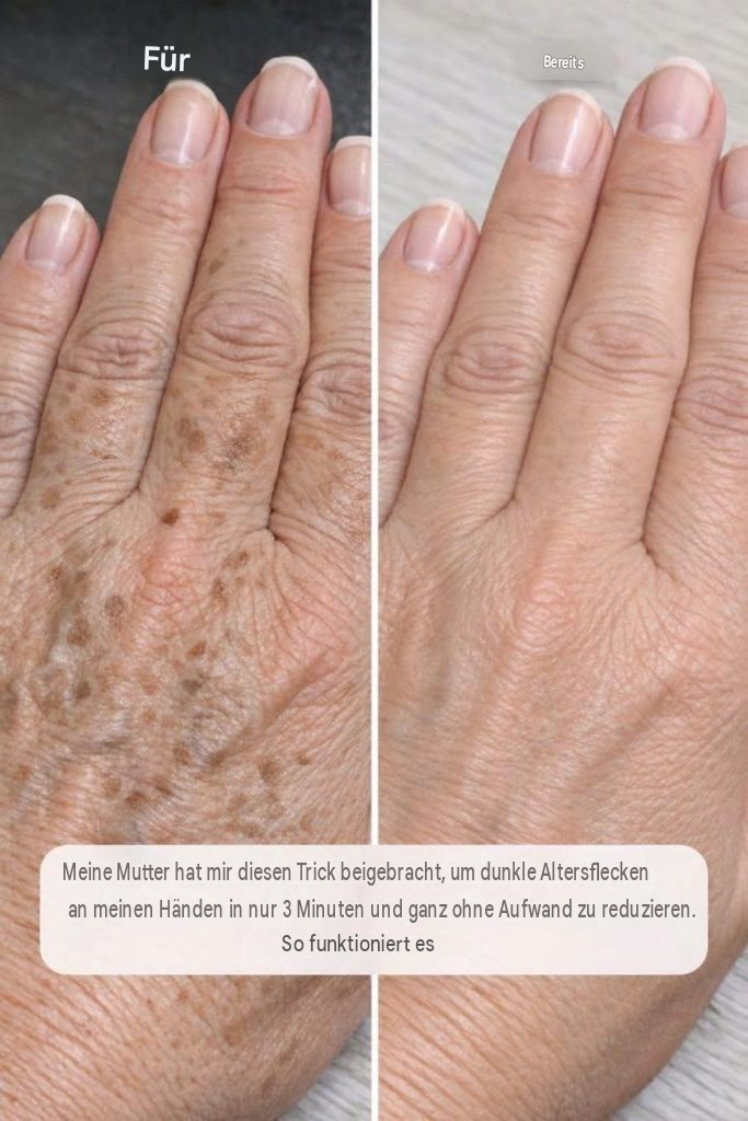Meine Mutter hat mir diesen Trick beigebracht, um dunkle Altersflecken an meinen Händen in nur 3 Minuten und ganz mühelos zu reduzieren. So funktioniert es: