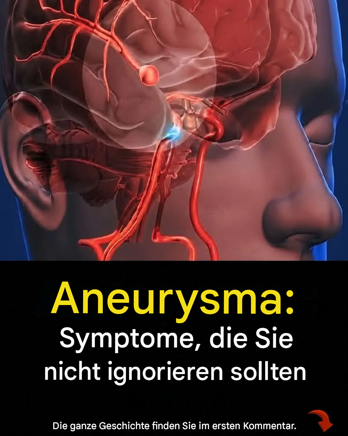 Aneurysma: 12 Warnzeichen, die Sie auf keinen Fall ignorieren sollten